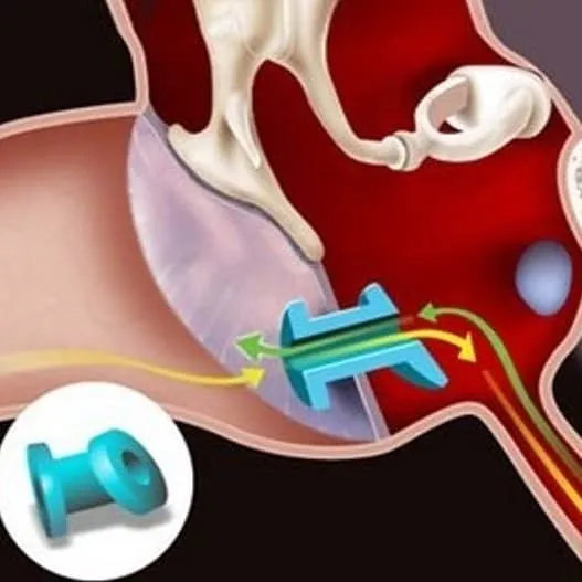 Diabolo dans les oreilles : que signifie ce bourdonnement et que faire chez soi